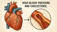 دور ارتفاع ضغط الدم والكوليسترول في تدمير الشرايين تدريجيًا دون ألم